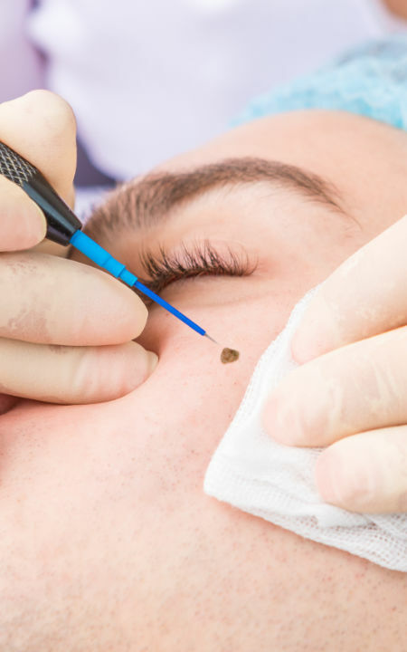 Electrocautery is a safe procedure that is routinely used by doctors and highly trained aestheticians to remove unwanted skin growths such as warts and skin tags.