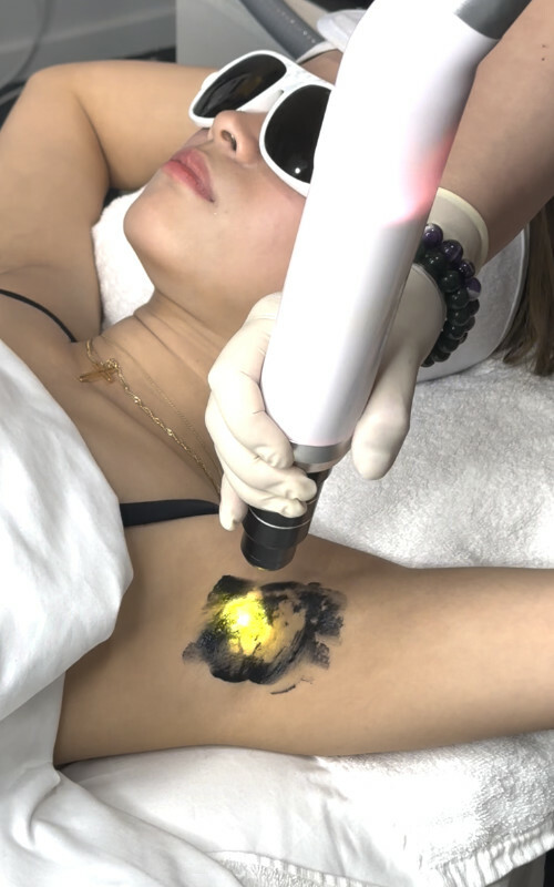 Angel White laser & Bio-micro peels are used in combination to lighten the underarm area.
