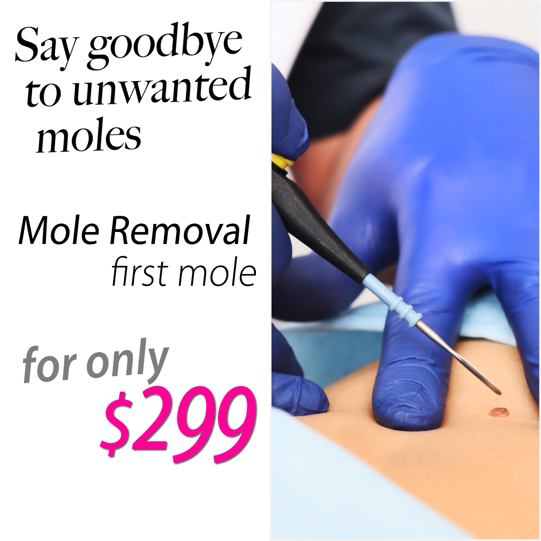 Safely remove unwanted moles with our expert mole removal service for just $299.