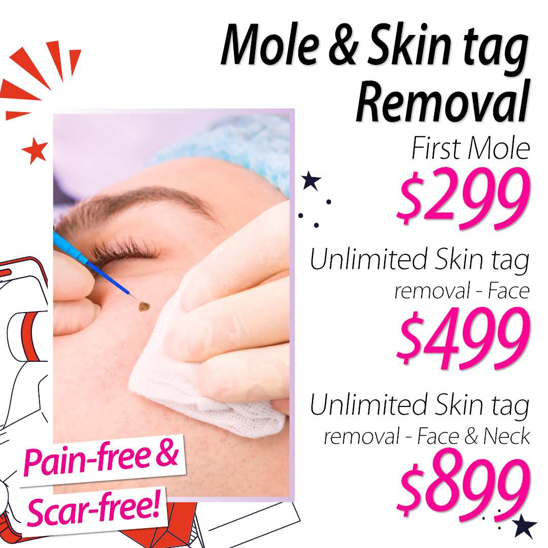This is a very limited time offer.
First mole removed for only $299.
Unlimited skin tag removal - Face $499 - Face & neck $899.