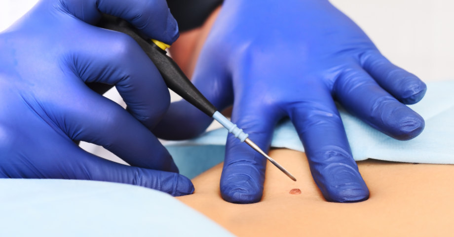 Electrocautery—a precise technique that uses controlled heat to eliminate wart tissue while simultaneously sealing blood vessels—offers a highly effective solution.