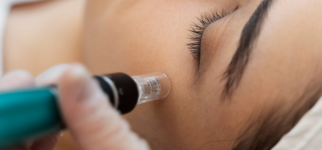 When performed professionally, microneedling has minimal long-term side effects. In fact, consistent sessions help maintain collagen production over time, slowing visible aging.