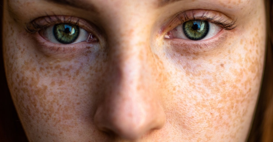 Freckles often show up during childhood, and you may continue to get more until you're in your 20s. People with fair skin or red hair are most likely to have them.