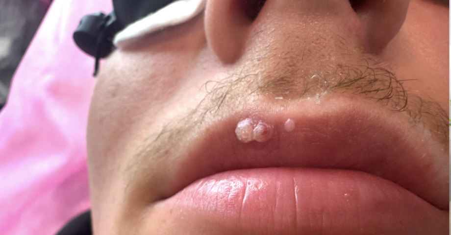 Our patient had three noticeable warts on his upper lip. One was small, but the others were larger and more bothersome.