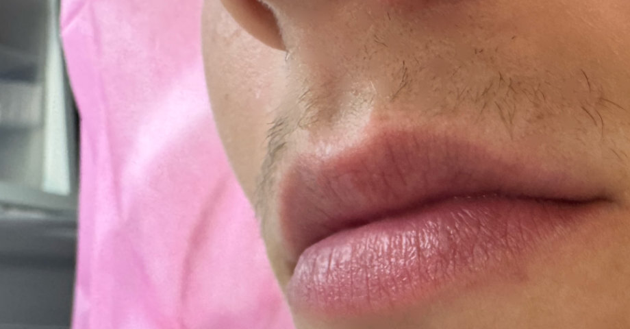 Just a few weeks after the procedure, the patient’s upper lip healed beautifully — no scars, no discomfort, and most importantly, no more warts!