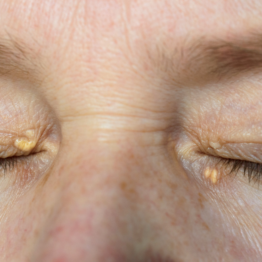 What is Xanthelasma? Curious about those yellowish spots around the eyelids? Xanthelasma might be the cause! While mostly cosmetic, it can be a sign of high cholesterol. Check out our latest blog to learn about causes, treatments, and prevention tips for xanthelasma.