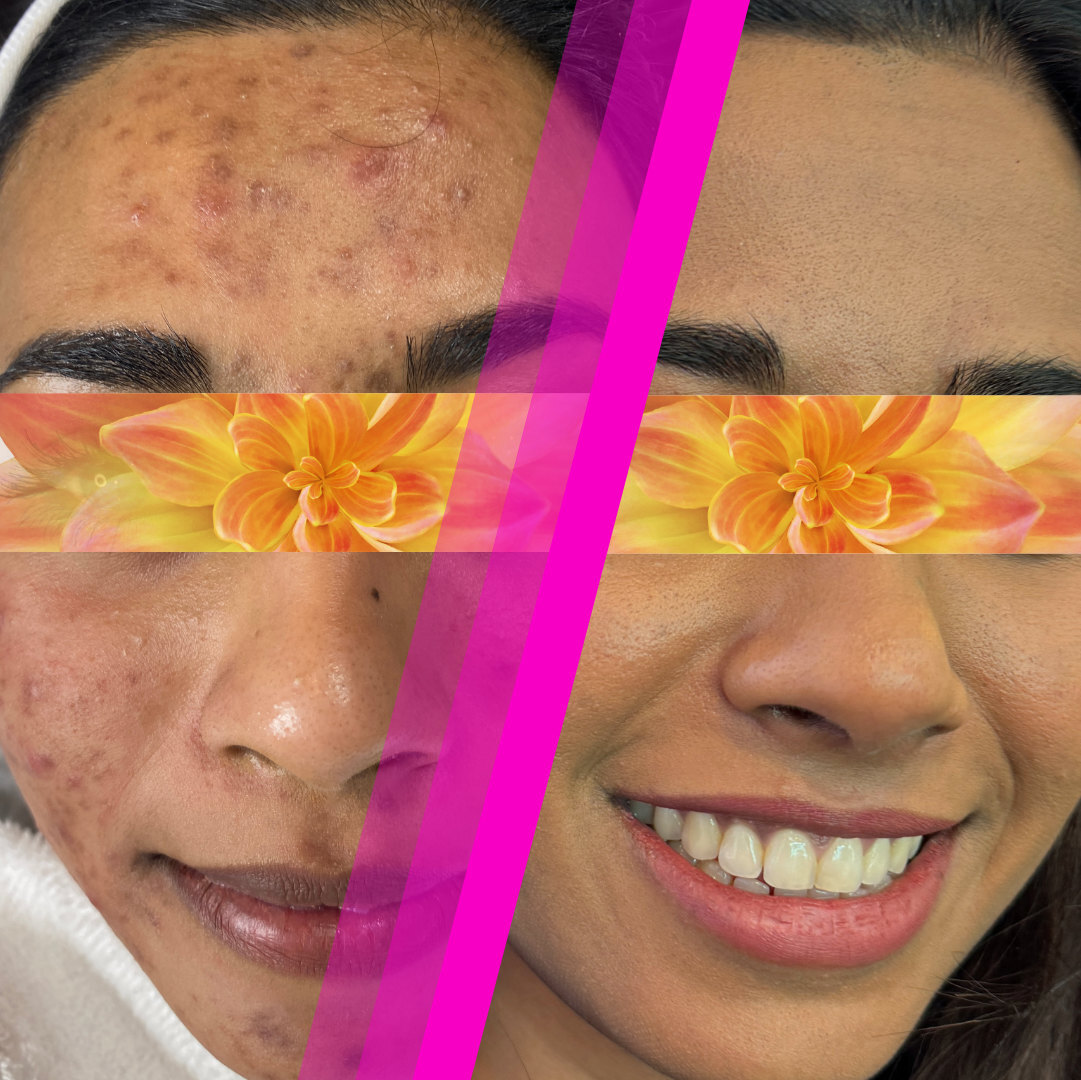 Miss S.'s first visit, then the change to her final CO2 laser resurfacing