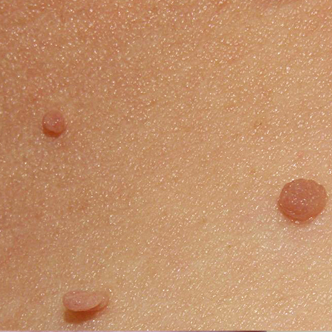 Skin tags are usually harmless, but they can be painful when snagged by jewellery or clothing. If these growths are bothersome or unsightly, we offer a permanent solution. Removing them with electrocautery leaves a barely noticeable scar, and will never grow back.