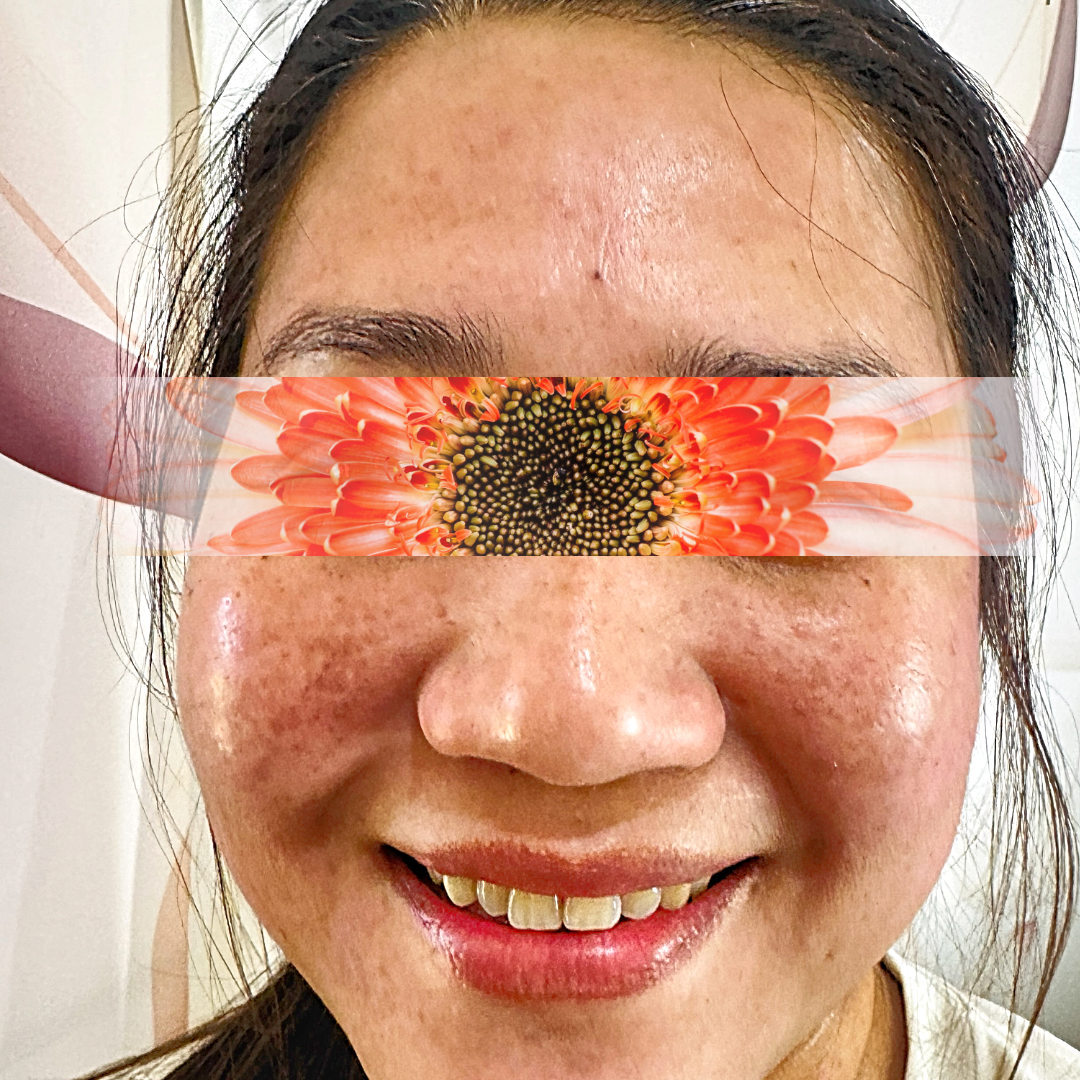 For years, Mrs. K struggled with melasma, enlarged pores, age spots, and uneven skin texture.
