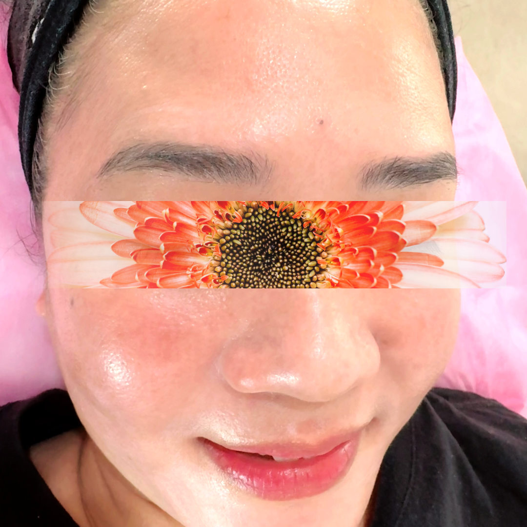 Using medical-grade products combined with advanced technology, we safely targeted the melasma. And within just 3 weeks… she started seeing visible improvement.