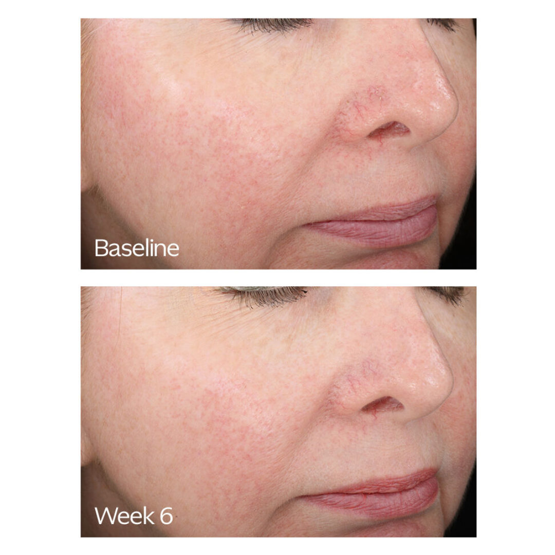 From the beginning to 6 weeks after the treatment started.