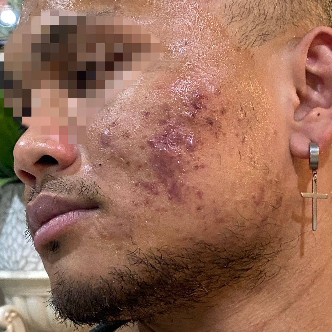 30 year old male with severe acne.