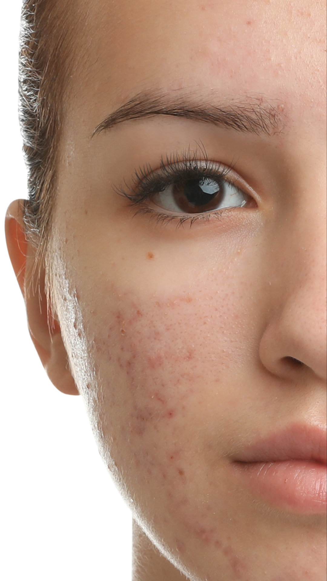 Acne treatments: Acnelan®, Post–acne treatments, PicoSure®, Acne peels, LED light