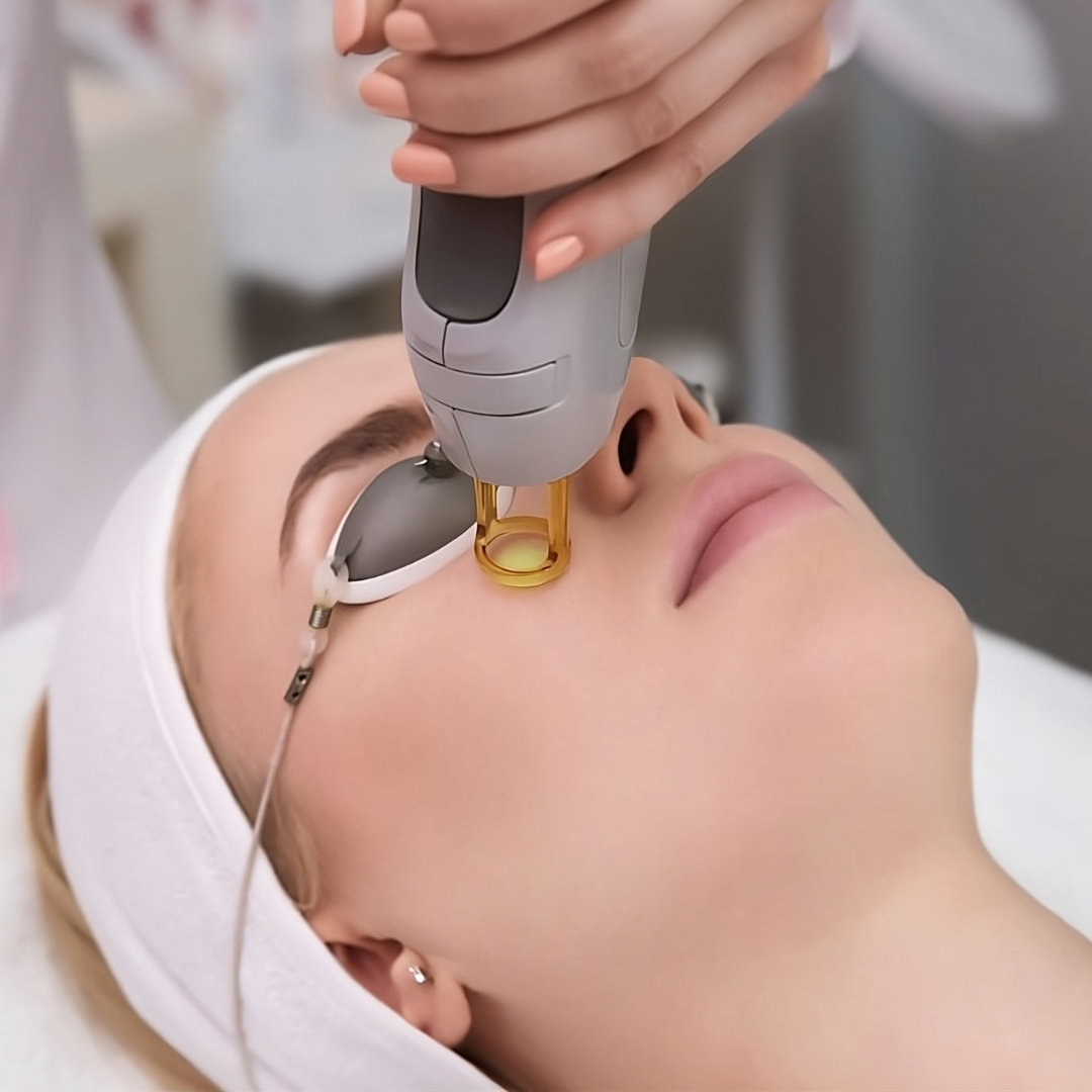 Your complete guide to CO2 Laser Resurfacing